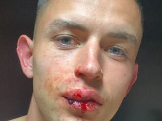 Álvaro Fidalgo mostró su labio roto, tras codazo de Alan Cervantes