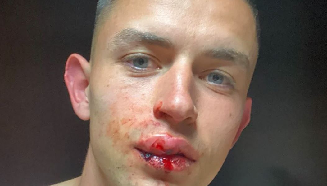 Álvaro Fidalgo mostró su labio roto, tras codazo de Alan Cervantes