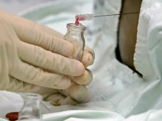 Con sangre de cordón umbilical curan a paciente con VIH