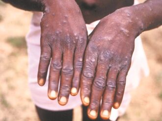 Enciende México alerta por viruela del mono