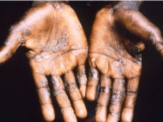 Registra México el segundo caso de viruela del mono