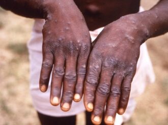 Se registran más de 5 mil 300 casos de viruela del mono a nivel mundial