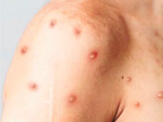 Confirman españoles la segunda muerte por viruela del mono