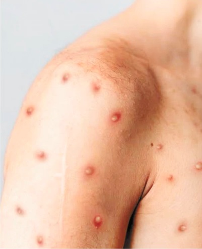 Confirman españoles la segunda muerte por viruela del mono