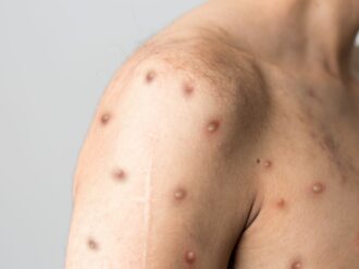 México dentro de los países con más casos de viruela del mono en Latinoamérica