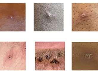 Viruela del mono no tarda en ser declarada pandemia, advierte experto de la OMS