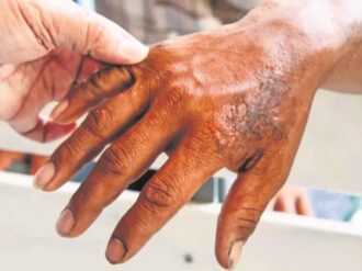 Secretaría de Salud vigila 12 municipios de México por casos de lepra