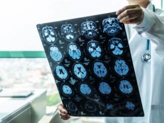 Pacientes que recibieron hormonas de crecimiento, contrajeron Alzheimer