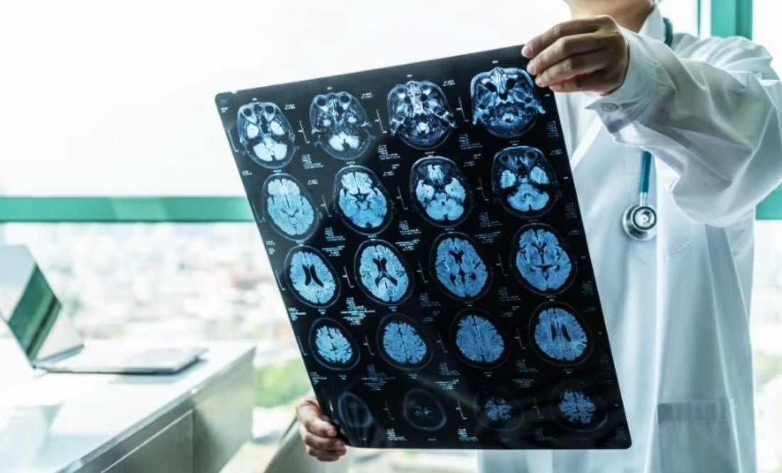 Pacientes que recibieron hormonas de crecimiento, contrajeron Alzheimer