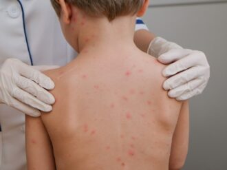 Suman 16 casos de sarampión en Zacatecas