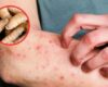 Aumentan casos de miasis en humanos por GBG