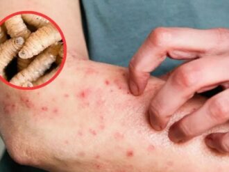 Aumentan casos de miasis en humanos por GBG