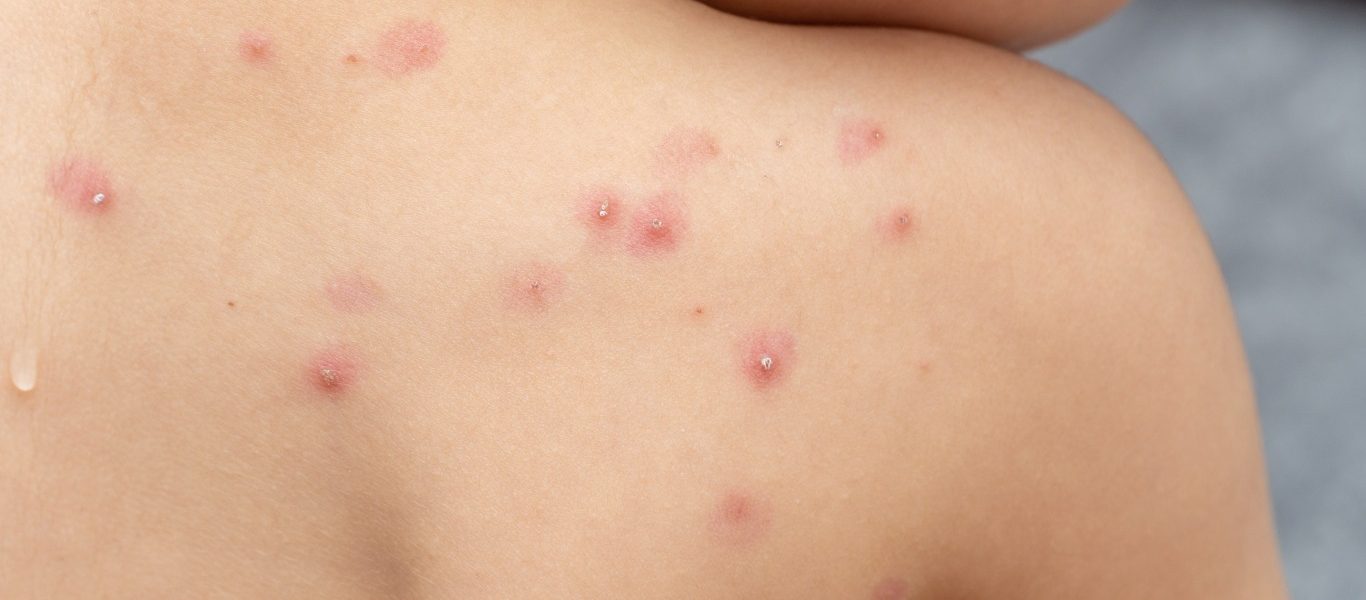EEUU declara a la viruela del mono como emergencia de salud publica