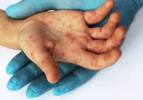 Viruela del Mono, hay mas de 500 casos en 30 países