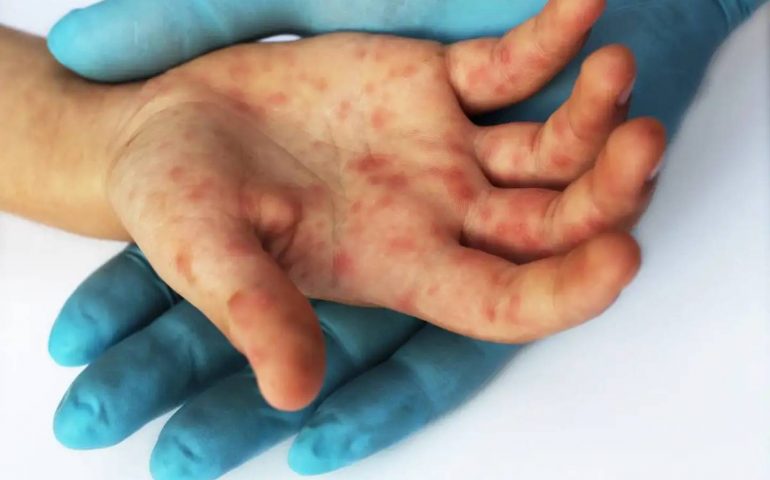 Viruela del Mono, hay mas de 500 casos en 30 países