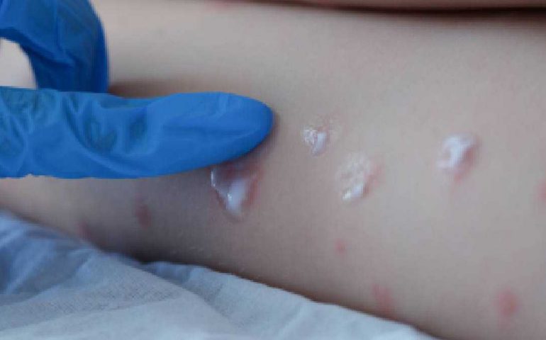 Se confirma primer caso de la Viruela del Mono en México
