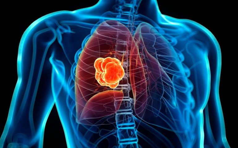Cancer de pulmon, uno de los cánceres más frecuentes en México