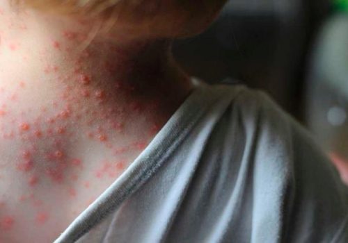 Viruela del Mono, Salud emite aviso epidemiológico