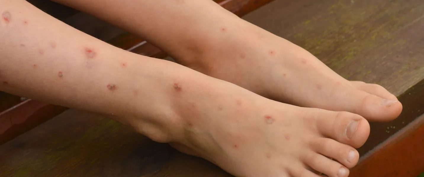 Se extiende la Gripe del Tomate en menores de la India