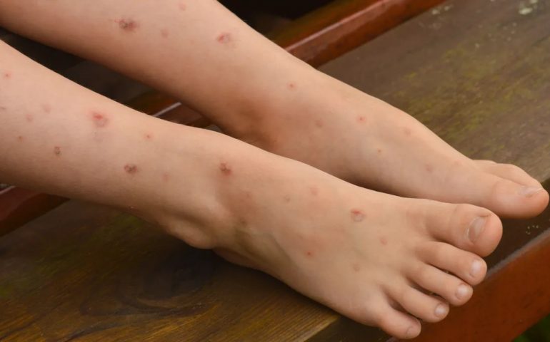 Se extiende la Gripe del Tomate en menores de la India