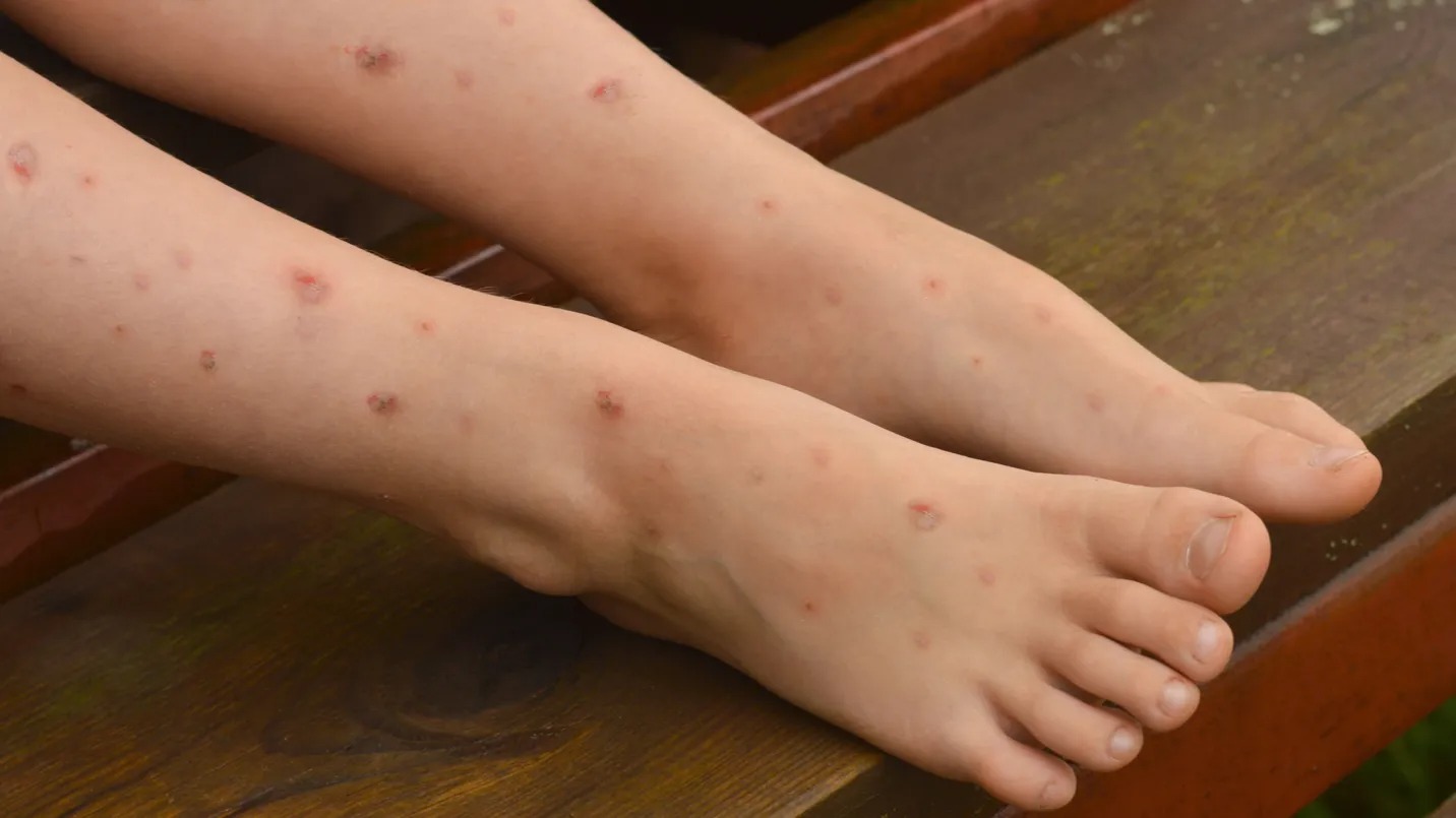 Se extiende la Gripe del Tomate en menores de la India