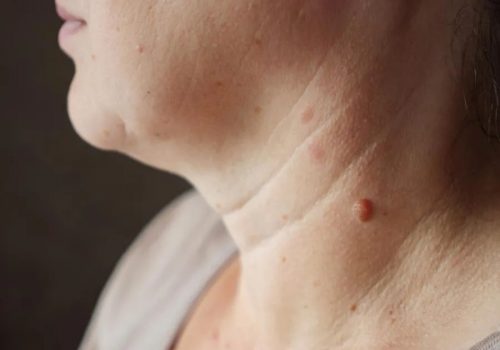 Verrugas en el cuello, ¿Que son y como elimínalas?
