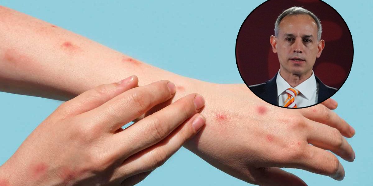 Viruela del mono no se comportará como el Covid-19: Gatell