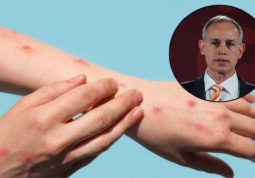 Viruela del mono no se comportará como el Covid-19: Gatell