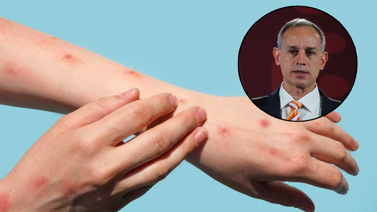 Viruela del mono no se comportará como el Covid-19: Gatell