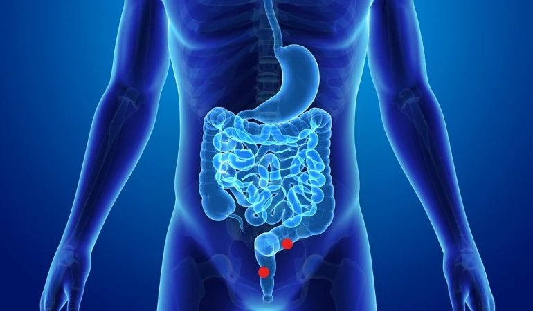 Cáncer de colon: causas, tipos, prevención y síntomas