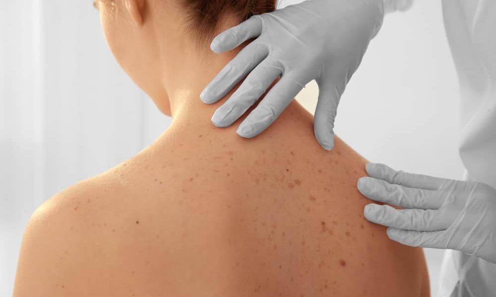 El sol, gran causante de cáncer de piel